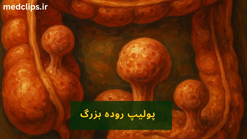 پولیپ روده