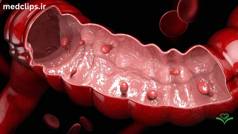 پولیپ روده بزرگ: شناخت، تشخیص و درمان گامبهگام 2 پولیپ روده (Intestinal Polyps ) چیست؟