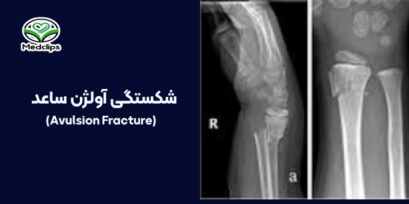 شکستگی ساعد: علائم، انواع، درمان و مراقبت ها 5 شکستگی آولژن